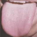 Pale tongue with white and thin coating